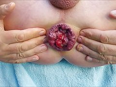 Self anal fisting my dirty prolapse